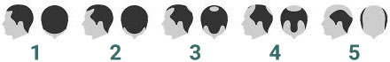 Hair Loss Stages Chart