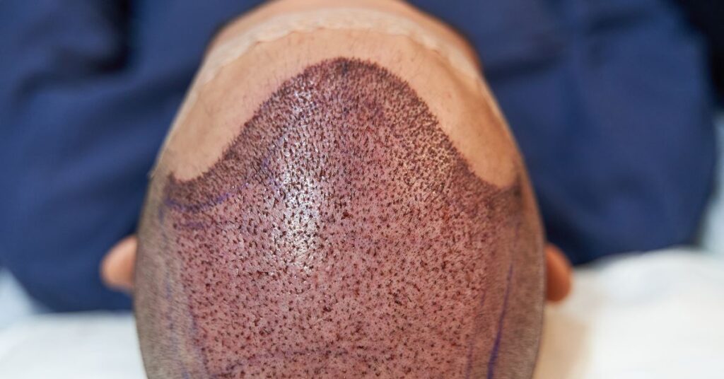 hair transplant cost in Hyderabad