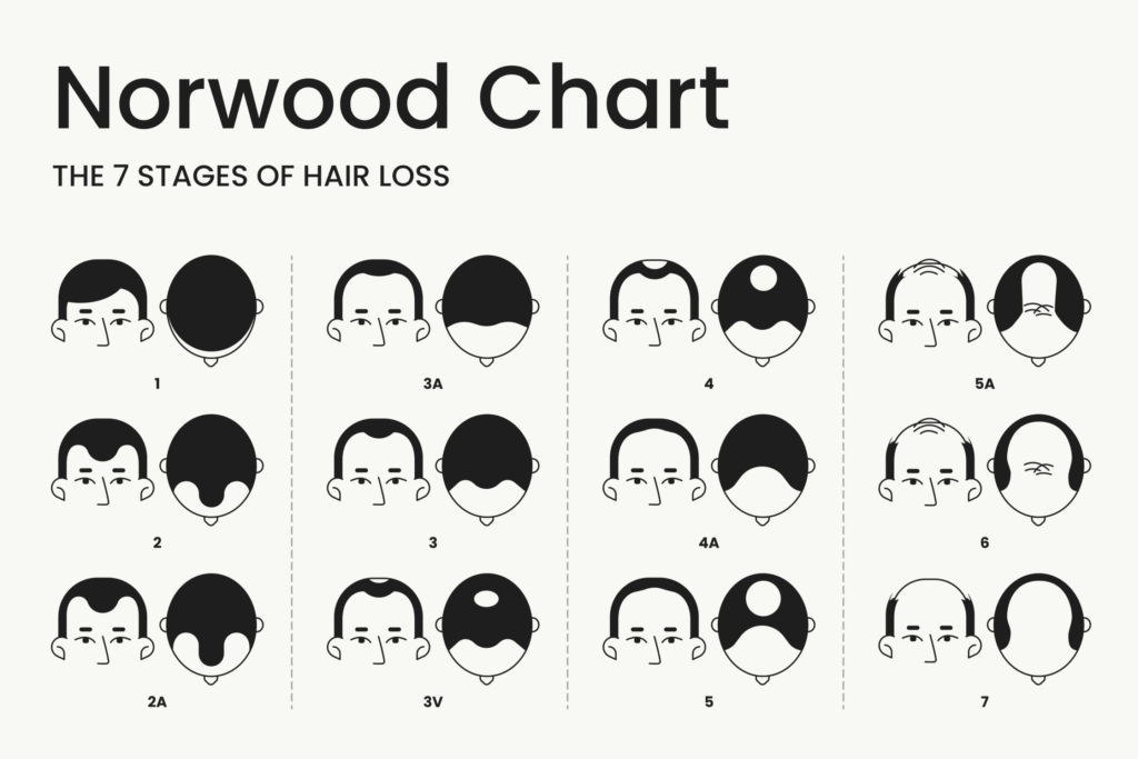 hair graft estimation Norwood scale Hyderabad clinic