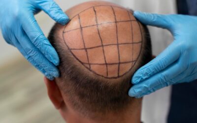 Hair Transplant Cost in Hyderabad: Complete Price Guide (2026)